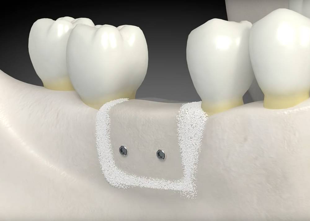 наращивания костной ткани при имплантации зубов
