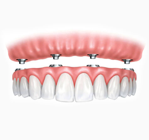 Имплантация зубов All-on-4 МедсемьяДент