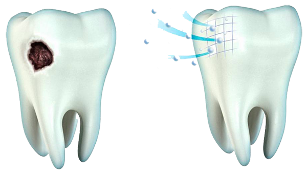 Профессиональные способы реминерализации зубов МедсемьяДент