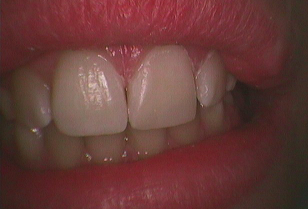 Фото реставрация зубов